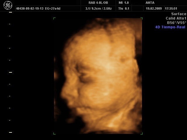 ecografía 4d bebé